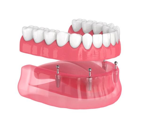 Full Mouth Implant