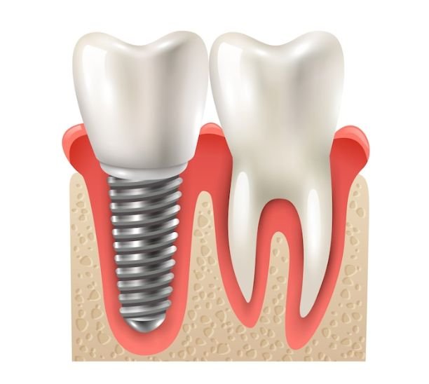 Dental Implant