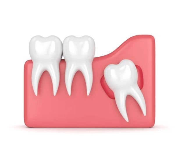 Wisdom Tooth Surgery